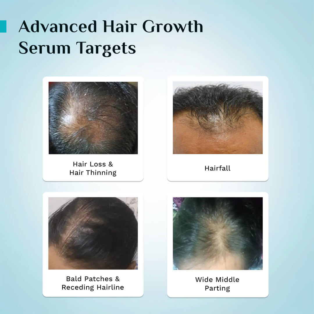 Pilgrim 3% Redensyl, 4% Anagain & 5% Capilia Stem Cell Complex Advanced Hair Growth Serum Roll-On, 30ml - Image 9 - Buy from Indicrest
