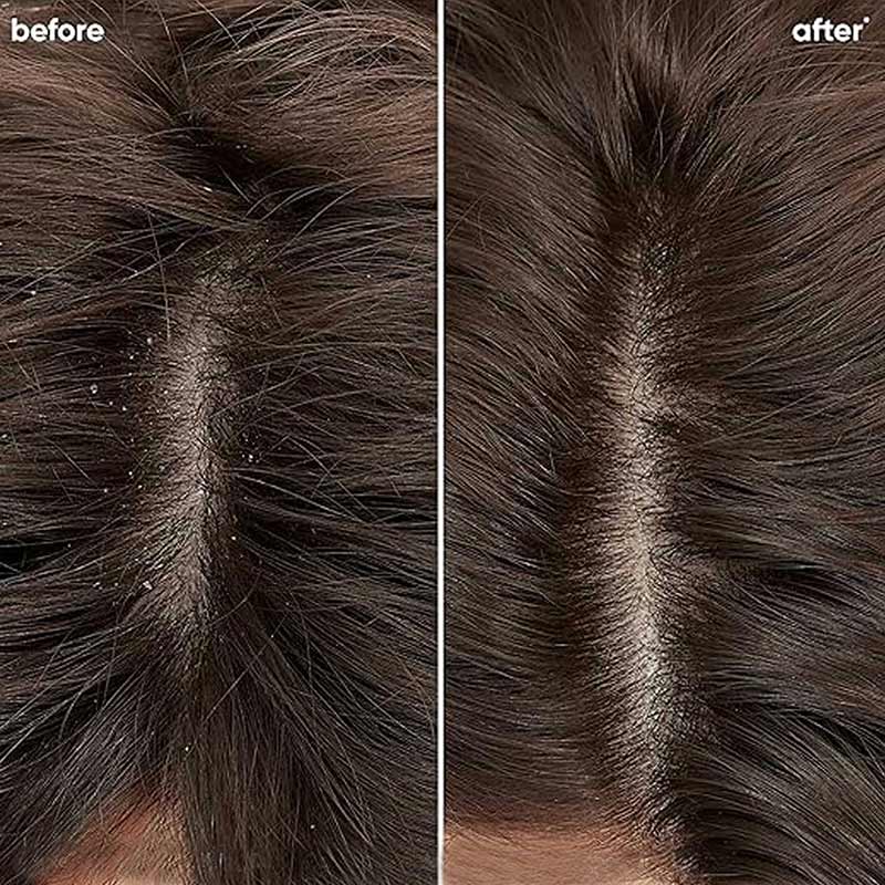 Biolage Scalppure Professional Anti-Dandruff Shampoo, Removes Visible Flakes After 1st WASH, 400ml Buy at Indicrest Image 2