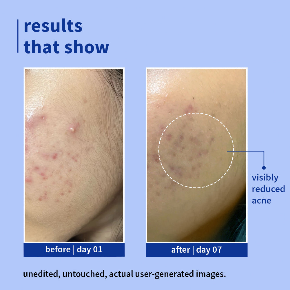 Plum Plum 1% Salicylic Acid Clearly Gentle Gel Face Wash with Blueberry | Helps Fight Active Acne | Gentle & Non-Drying | For Oily, Acne-Prone Skin | Beginner-Friendly | All Genders | 100% Vegan | 100 Ml, 100ml