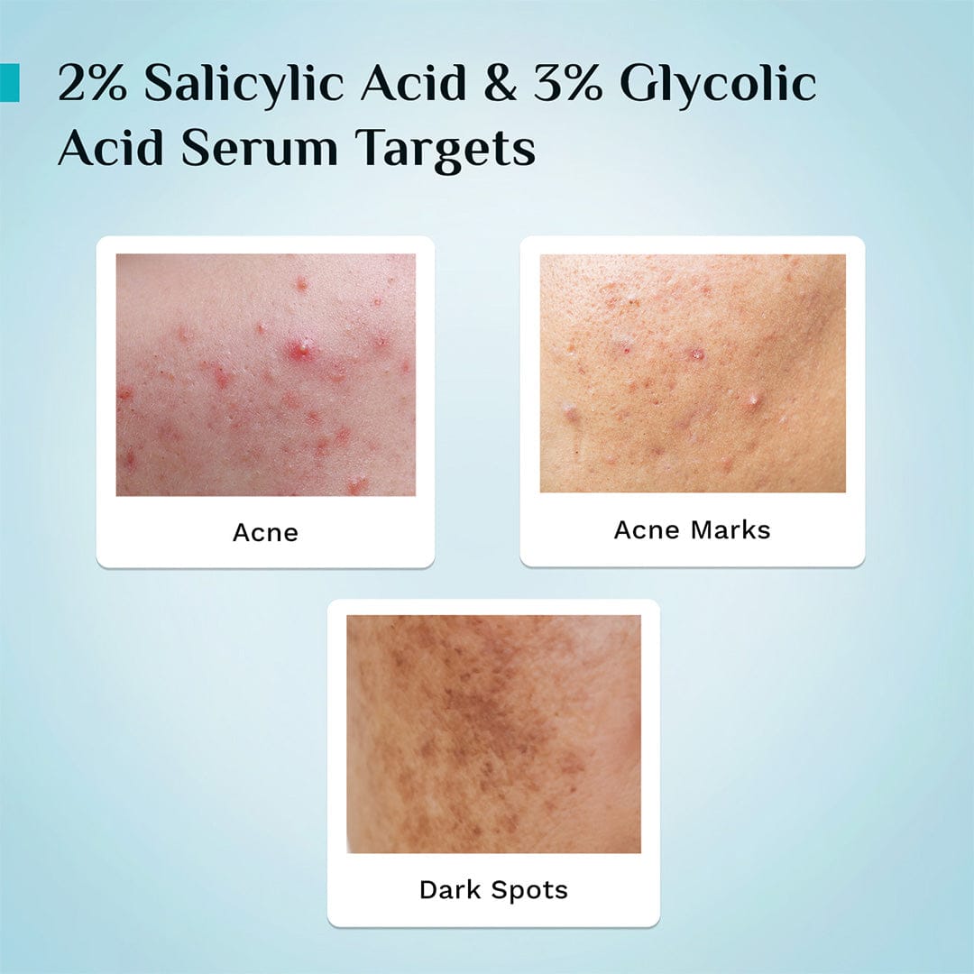 Pilgrim 2% Salicylic Acid Anti-Acne Face Serum, 30ml - Image 5 - Buy from Indicrest