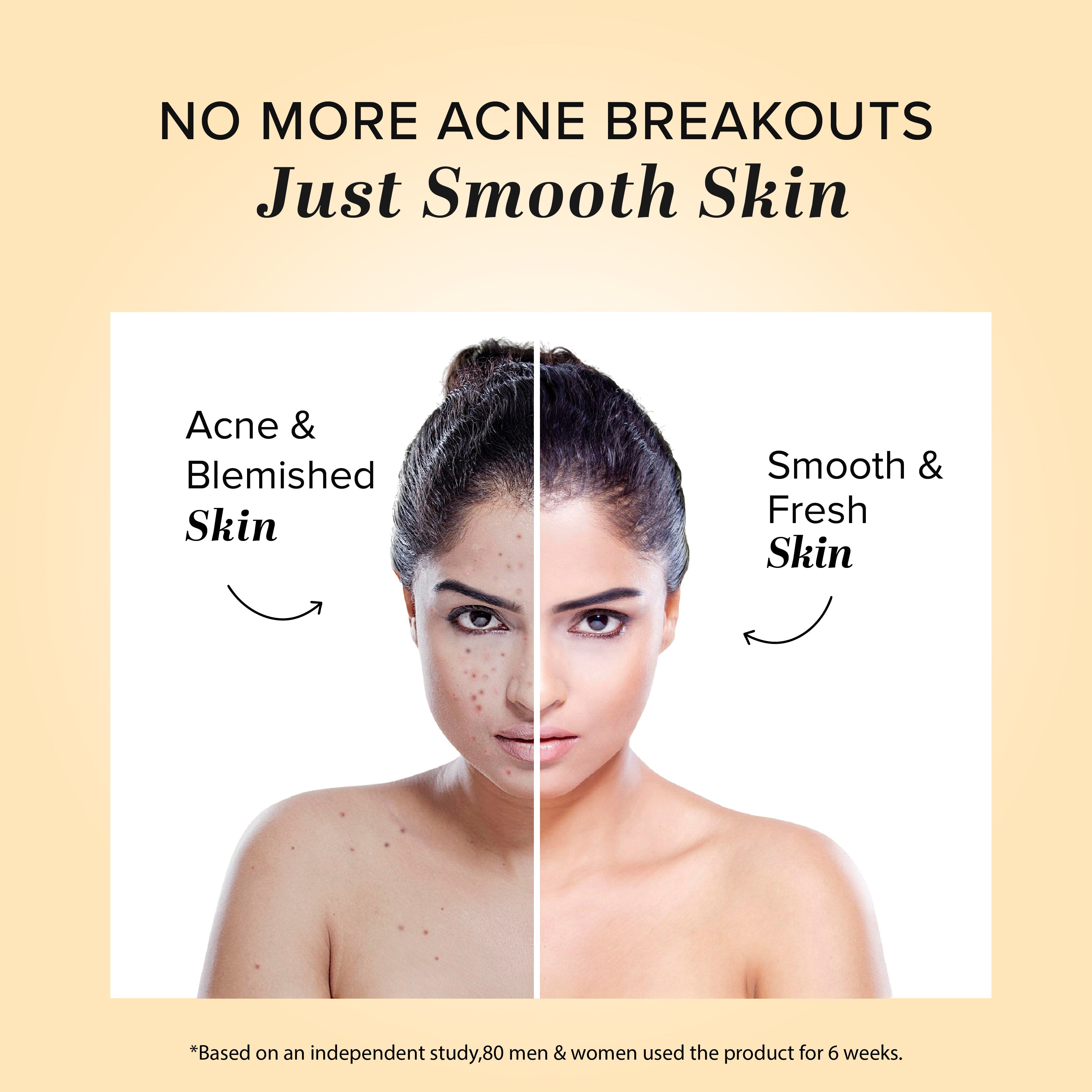Khadi Natural Herbal Acne Pimple Cream - 50gm - Image 5 - Buy from Indicrest