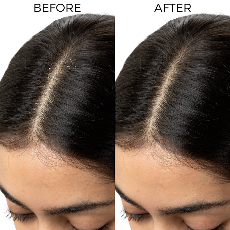Brillare Lactylate Shampoo To Reduce Dandruff, 200ml - Image 6 - Buy from Indicrest