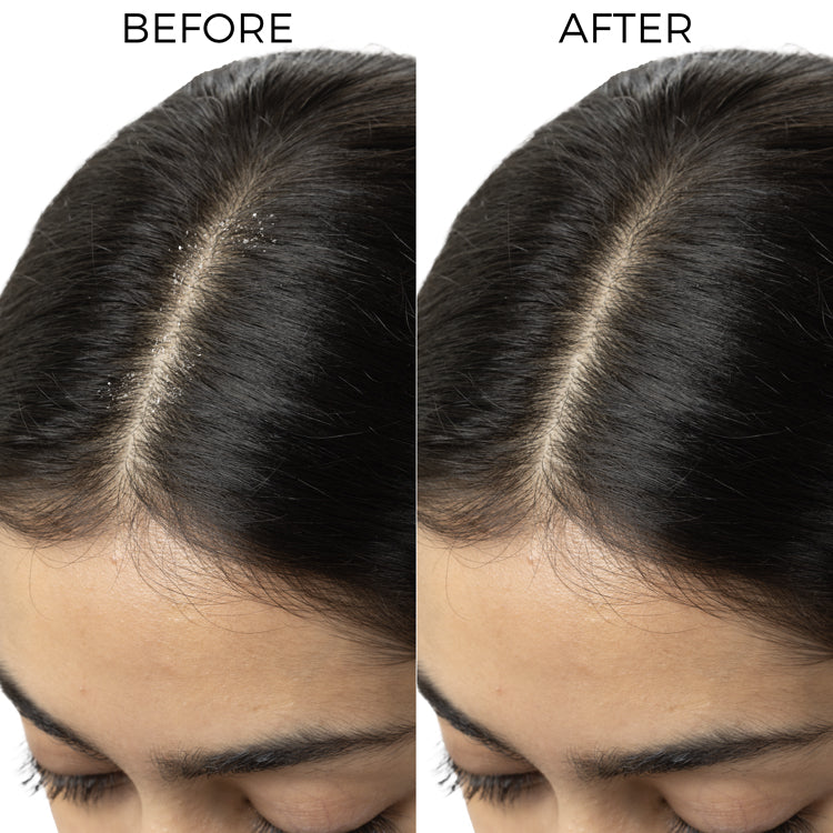 Brillare Tea Tree Hair Oil for Dandruff Control, 100ml - Image 6 - Buy from Indicrest
