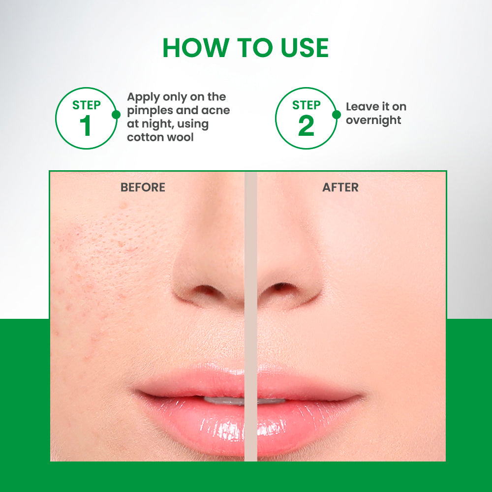 Shahnaz Husain Shaclear Plus Skin Clear Anti-Pimple Lotion, 100ml - Image 5 - Buy from Indicrest