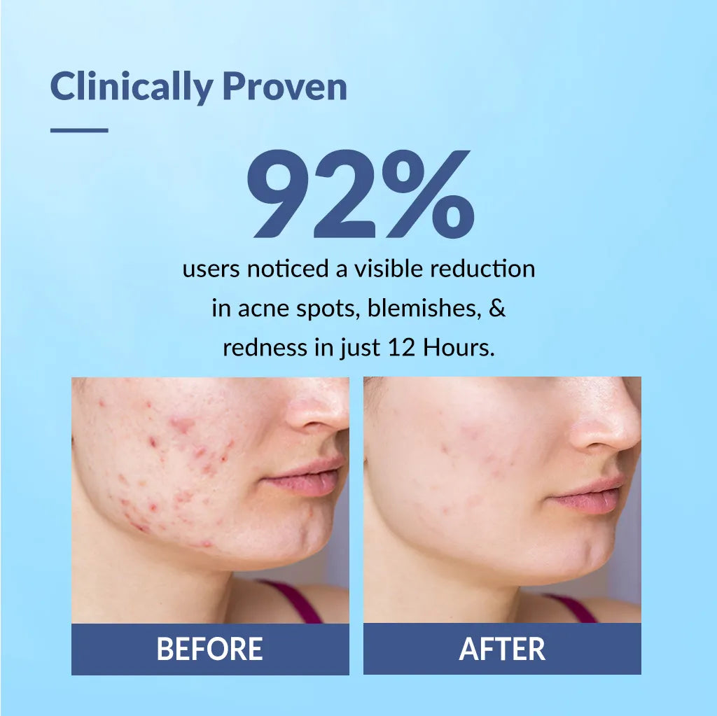 Fixderma Salyzap Acne Spot Corrector Gel, 20g - Image 2 - Buy from Indicrest