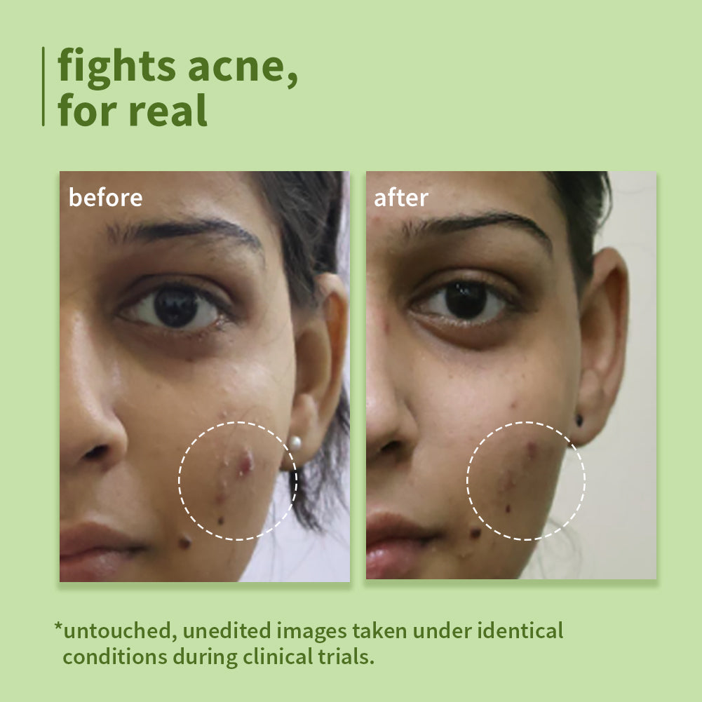 Plum Green Tea Pore Cleansing Face Wash for Acne | Controls Oil Upto 2-Hrs | Reduces Acne In 7 Days, 150ml