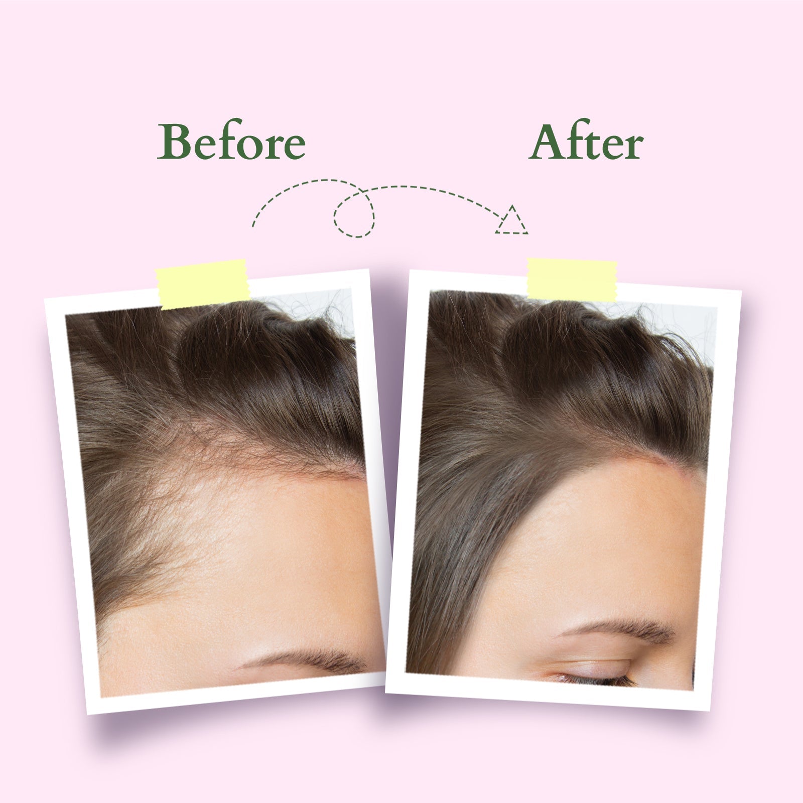 Lotus Herbals Organics+ Hair Growth Active-Concentrate Serum, 28ml