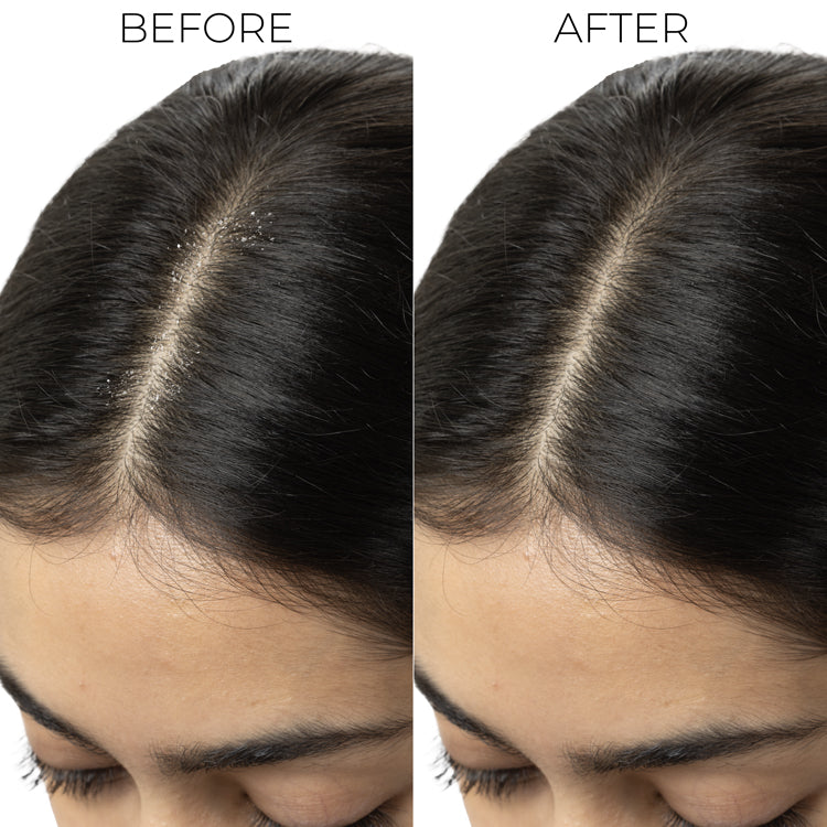 Brillare Mini Lactylate Scalp Serum for Dandruff Control, 5ml - Image 4 - Buy from Indicrest