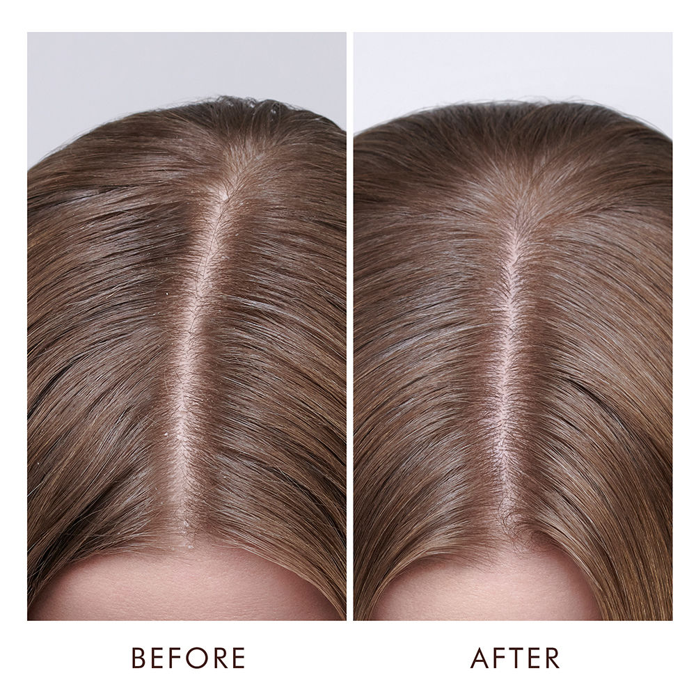 Moroccanoil Dry Scalp Treatment | With Salicylic Acid, Argan & Vitamin E | Soothes & Reduces Flakes, 45ml