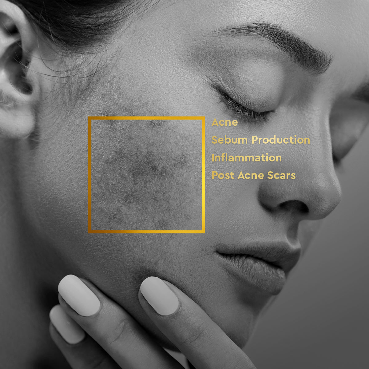 VLCC Acne Control Regime - Acne Reduction and fights acne causing germs - Image 2 - Buy from Indicrest