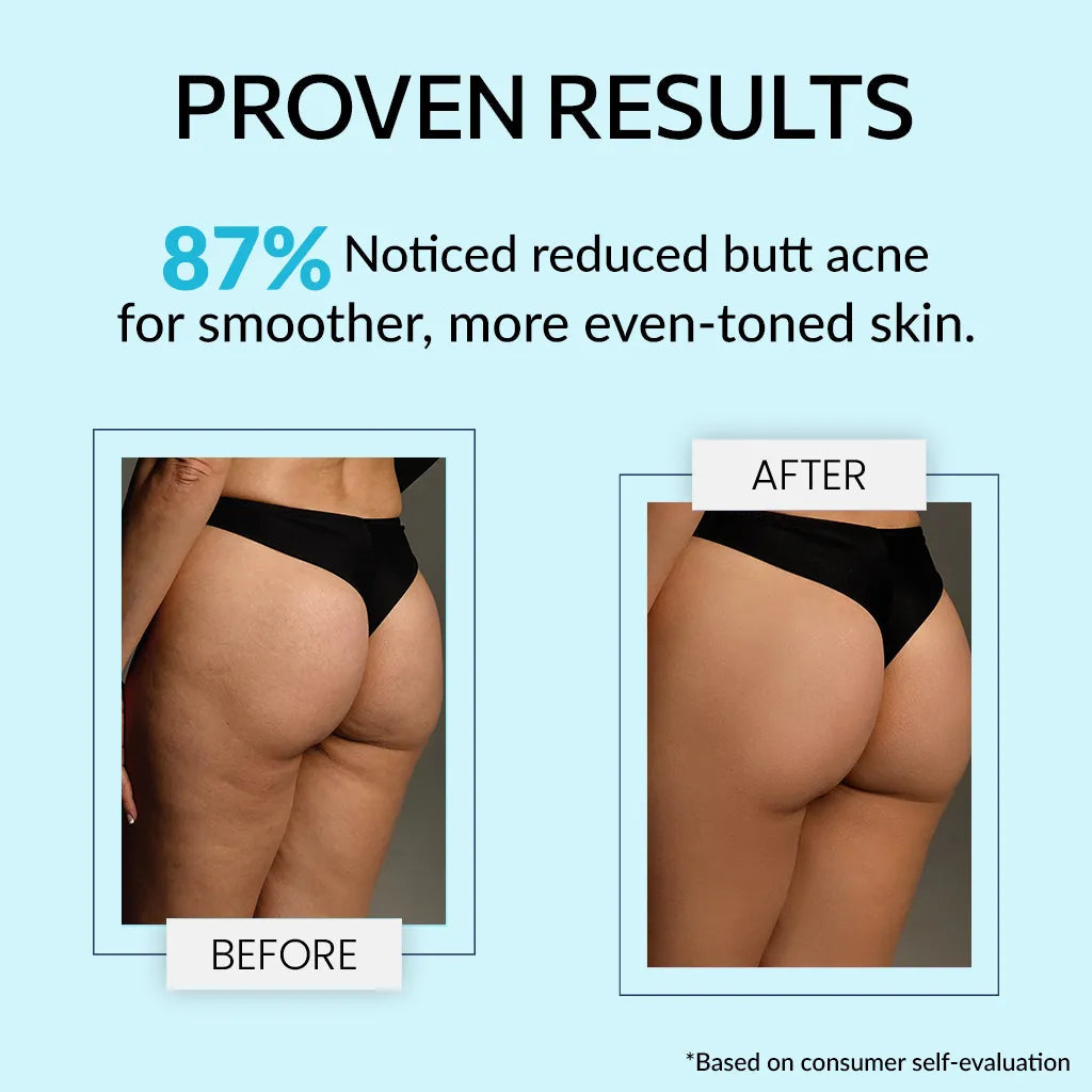 Fixderma Teenilicious Bum Body Cream | For Butt Acne With Retistar & Shea Butter, 100g - Image 4 - Buy from Indicrest