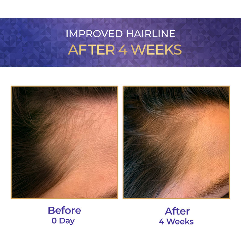 Streax Vitagrowth Hair Serum with 3% Redensyl, 3% Anagain, 3% Baicapil, Biotin & Caffeine, 30ml Buy at Indicrest Image 5