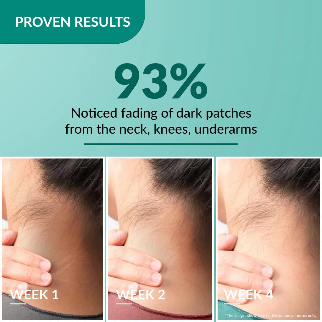 Fixderma Nigrifix Cream 50g Pack of 2 | Treat pigmentation associated with Acanthosis Nigricans - Image 4 - Buy from Indicrest